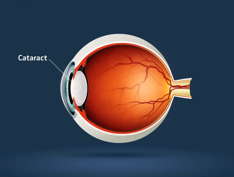 Advanced Cataract Surgery Eye Institute of South Jersey Cataracts